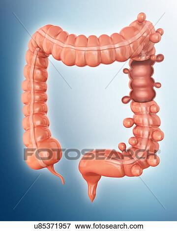 Stock Illustration - Human large intestine showing diverticulitis, computer illustration.. Fotosearch
