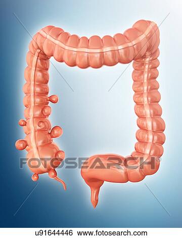 Stock Illustration - Human large intestine showing diverticulitis, computer artwork.. Fotosearch