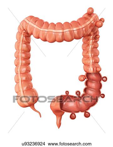 Human large intestine showing diverticulitis, computer artwork. View Large Illustration Stock Illustration - Human large intestine showing diverticulitis, computer artwork.. Fotosearch