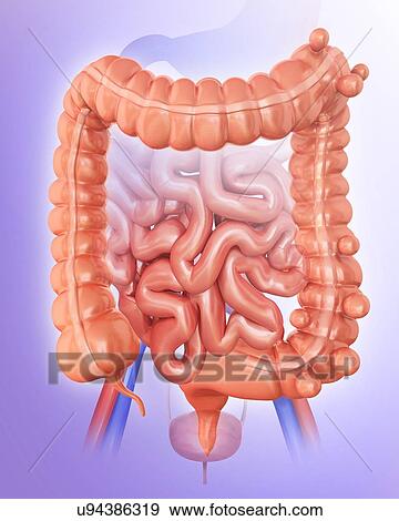 Stock Illustration - Human large intestine showing diverticulitis, computer illustration.. Fotosearch