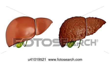 Clip Art - Human liver cirrhosis, computer artwork.. Fotosearch