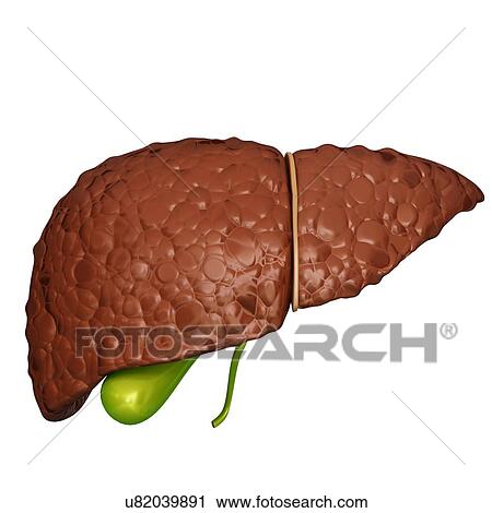 Clip Art - Human liver cirrhosis, computer artwork.. Fotosearch