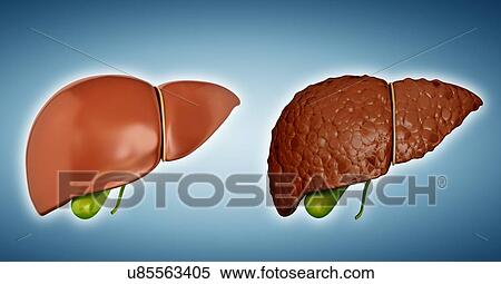Human liver cirrhosis, computer illustration. View Large Illustration Stock Illustration - Human liver cirrhosis, computer illustration.. Fotosearch