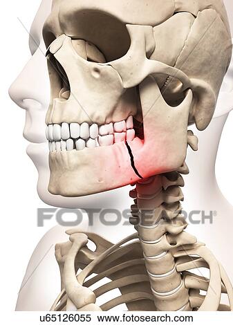 "Broken jaw bone, Illustration" View Large Illustration Stock Illustration - "Broken jaw bone, Illustration". Fotosearch