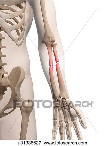 "Broken lower arm bones, Illustration" View Large Illustration Stock Illustration - "Broken lower arm bones, Illustration". Fotosearch
