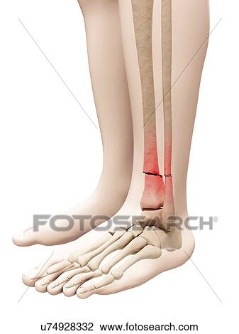 "Broken lower leg bones, Illustration" View Large Illustration Drawing - "Broken lower leg bones, Illustration". Fotosearch