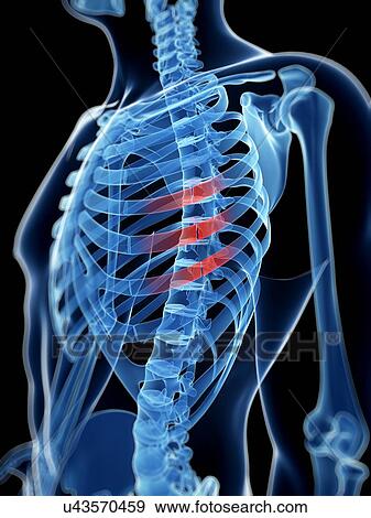 "Broken ribs, Illustration" View Large Illustration Stock Illustration - "Broken ribs, Illustration". Fotosearch