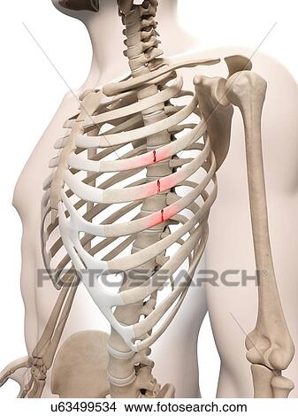 "Broken ribs, Illustration" View Large Illustration Stock Illustration - "Broken ribs, Illustration". Fotosearch