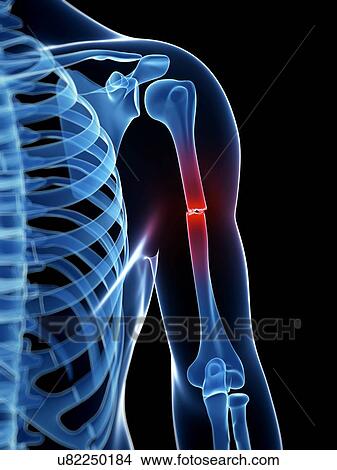 Stock Illustration - "Broken upper arm bone, Illustration". Fotosearch