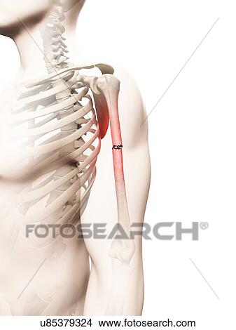 Stock Illustration - "Broken upper arm bone, Illustration". Fotosearch
