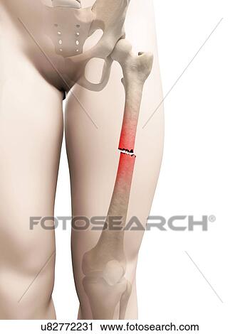 Clip Art - "Broken upper leg bone, Illustration". Fotosearch