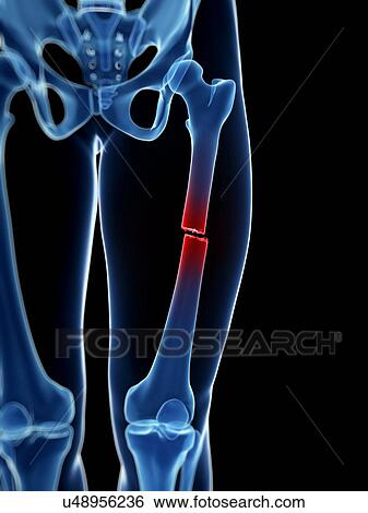 Stock Illustration - "Broken upper leg bone, Illustration". Fotosearch