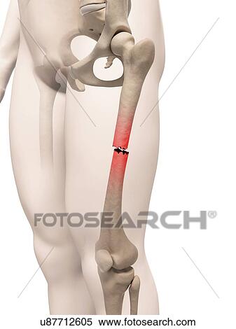 Stock Illustration - "Broken upper leg bone, Illustration". Fotosearch