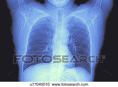 Clipart - CT scan of chest showing heart and lungs. Fotosearch