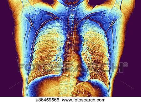Stock Illustration - CT scan of chest showing heart and lungs. Fotosearch