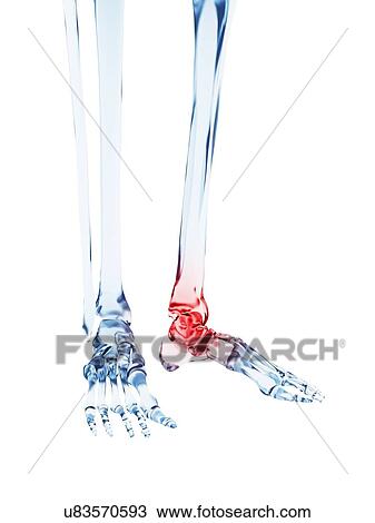 "Human ankle pain, Illustration" View Large Illustration Drawing - "Human ankle pain, Illustration". Fotosearch
