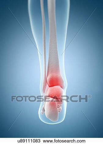 Drawing - "Human ankle pain, Illustration". Fotosearch