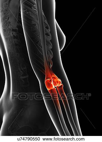 Clipart - "Human elbow pain, Illustration". Fotosearch
