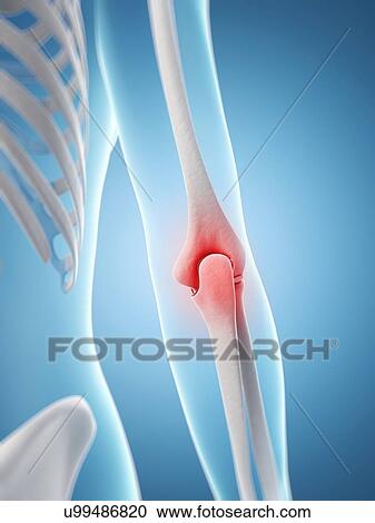 "Human elbow pain, Illustration" View Large Illustration Clipart - "Human elbow pain, Illustration". Fotosearch