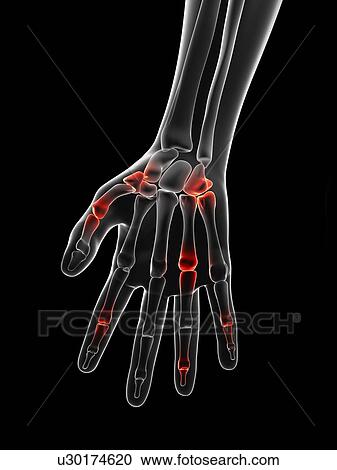 "Human finger joint pain, Illustration" View Large Illustration Clipart - "Human finger joint pain, Illustration". Fotosearch