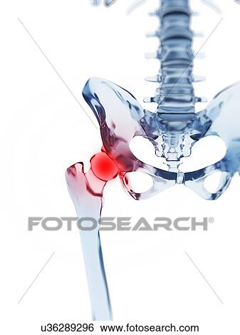 "Human hip pain, Illustration" View Large Illustration Stock Illustration - "Human hip pain, Illustration". Fotosearch