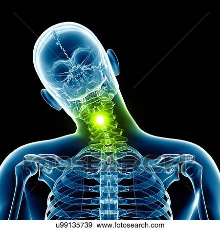 "Human neck bending sideways, Illustration" View Large Illustration Stock Illustration - "Human neck bending sideways, Illustration". Fotosearch