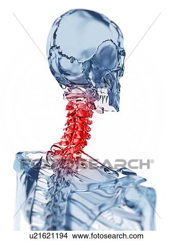 Stock Illustration - "Human neck pain, Illustration". Fotosearch
