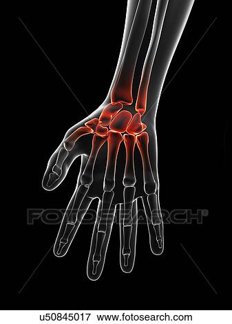 "Human wrist pain, Illustration" View Large Illustration Stock Illustration - "Human wrist pain, Illustration". Fotosearch
