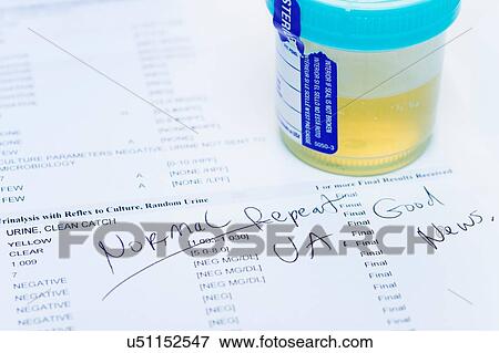 Studio shot of urine sample on test printout showing normal results. Testing is done as part of yearly health checkup View Large Photo Image Stock Photo - Studio shot of urine sample on test printout showing normal results. Testing is done as part of yearly health checkup. Fotosearch