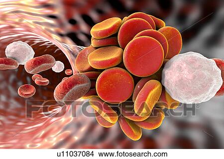 Blood clot, illustration View Large Illustration Stock Illustration - Blood clot, illustration. Fotosearch