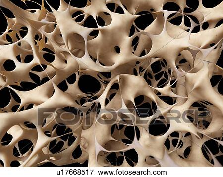 Stock Illustration - Bones with osteoporosis, illustration. Fotosearch