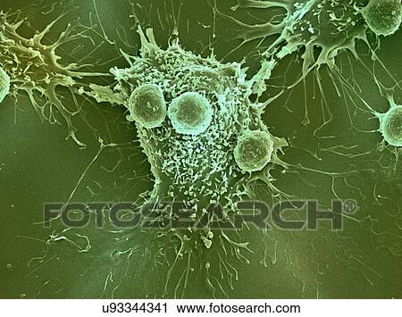 "Cancer cell and T lymphocytes, SEM" View Large Photo Image Stock Image - "Cancer cell and T lymphocytes, SEM". Fotosearch