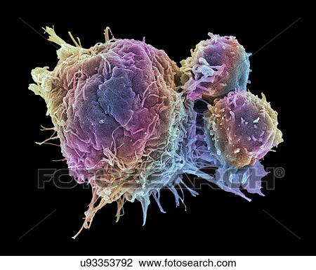 Stock Image - "Cancer cell and T lymphocytes, SEM". Fotosearch