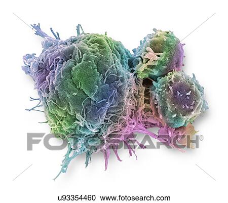 Stock Image - "Cancer cell and T lymphocytes, SEM". Fotosearch