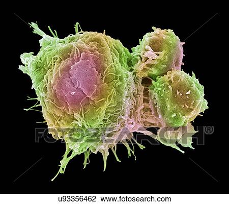 "Cancer cell and T lymphocytes, SEM" View Large Photo Image Stock Image - "Cancer cell and T lymphocytes, SEM". Fotosearch