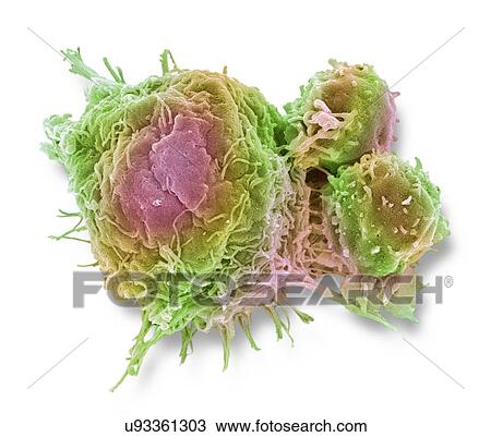 Stock Image - "Cancer cell and T lymphocytes, SEM". Fotosearch