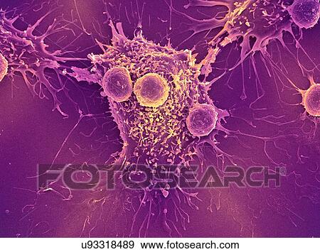 Stock Photo - "Cancer cell and T lymphocytes, SEM". Fotosearch