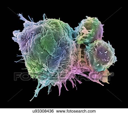 Stock Photograph - "Cancer cell and T lymphocytes, SEM". Fotosearch