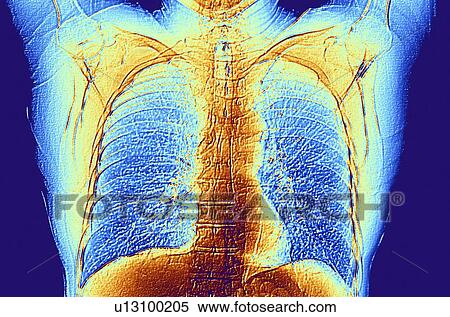Ct 走査 の 胸 提示 心 そして 肺 イラスト U Fotosearch