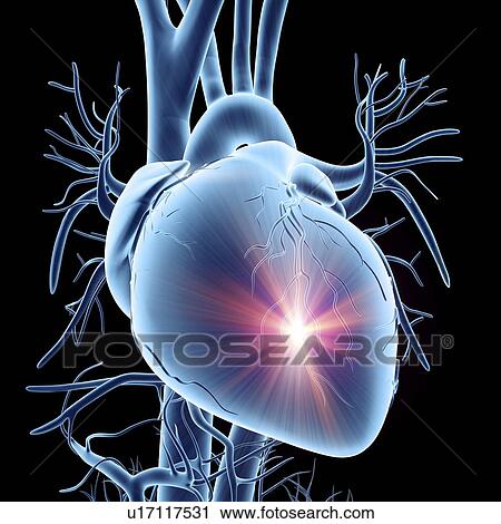 Heart attack, conceptual artwork View Large Illustration Clip Art - Heart attack, conceptual artwork. Fotosearch