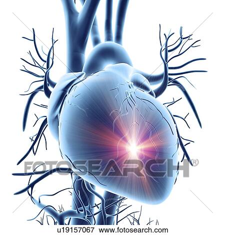 Heart attack, conceptual artwork View Large Illustration Stock Illustration - Heart attack, conceptual artwork. Fotosearch
