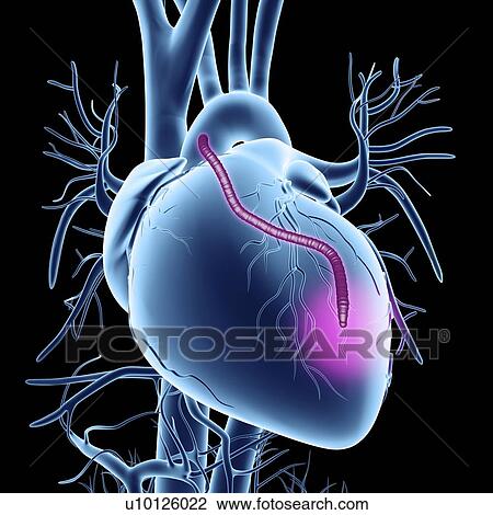 Heart bypass graft, artwork View Large Illustration Drawing - Heart bypass graft, artwork. Fotosearch