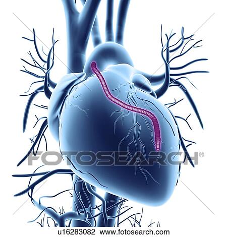 Heart bypass graft, artwork View Large Illustration Drawing - Heart bypass graft, artwork. Fotosearch