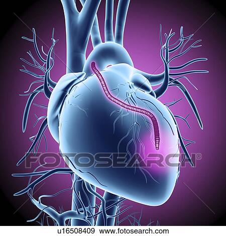 Heart bypass graft, artwork View Large Illustration Stock Illustration - Heart bypass graft, artwork. Fotosearch
