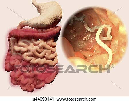 Clip Art - Human tapeworm infection, illustration. Fotosearch