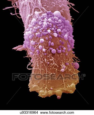 Picture - "Skin cancer cell, SEM". Fotosearch