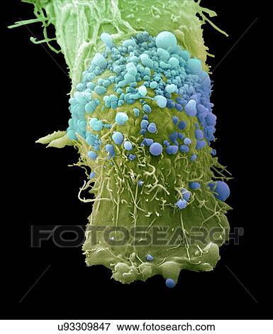 Stock Photo - "Skin cancer cell, SEM". Fotosearch