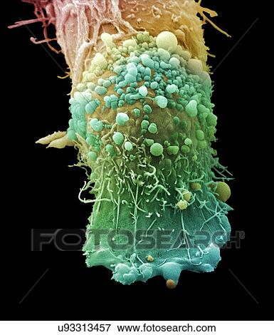 Stock Photo - "Skin cancer cell, SEM". Fotosearch