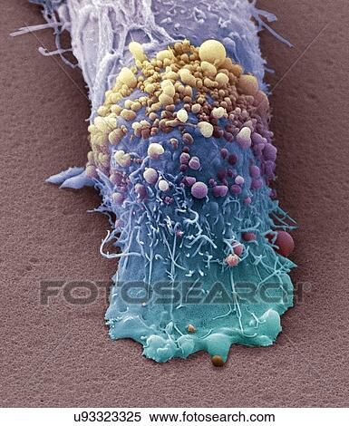 Stock Photography - "Skin cancer cell, SEM". Fotosearch