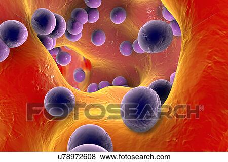 Stock Illustration - Staphylococcus infection, illustration. Fotosearch